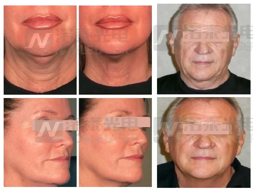 10000 Shots 3D Hifu 11 Lines Wrinkle Removal Noble Laser